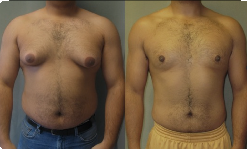 man boobs removed before and after results 